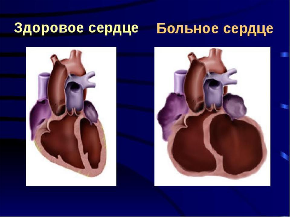 Здоровое сердце VS больное сердце с указанием роли гомоцистеина
